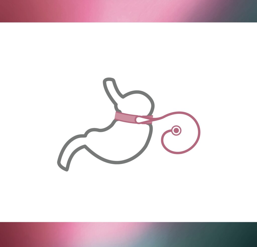 Laprascopic Adjustable Gastric Band