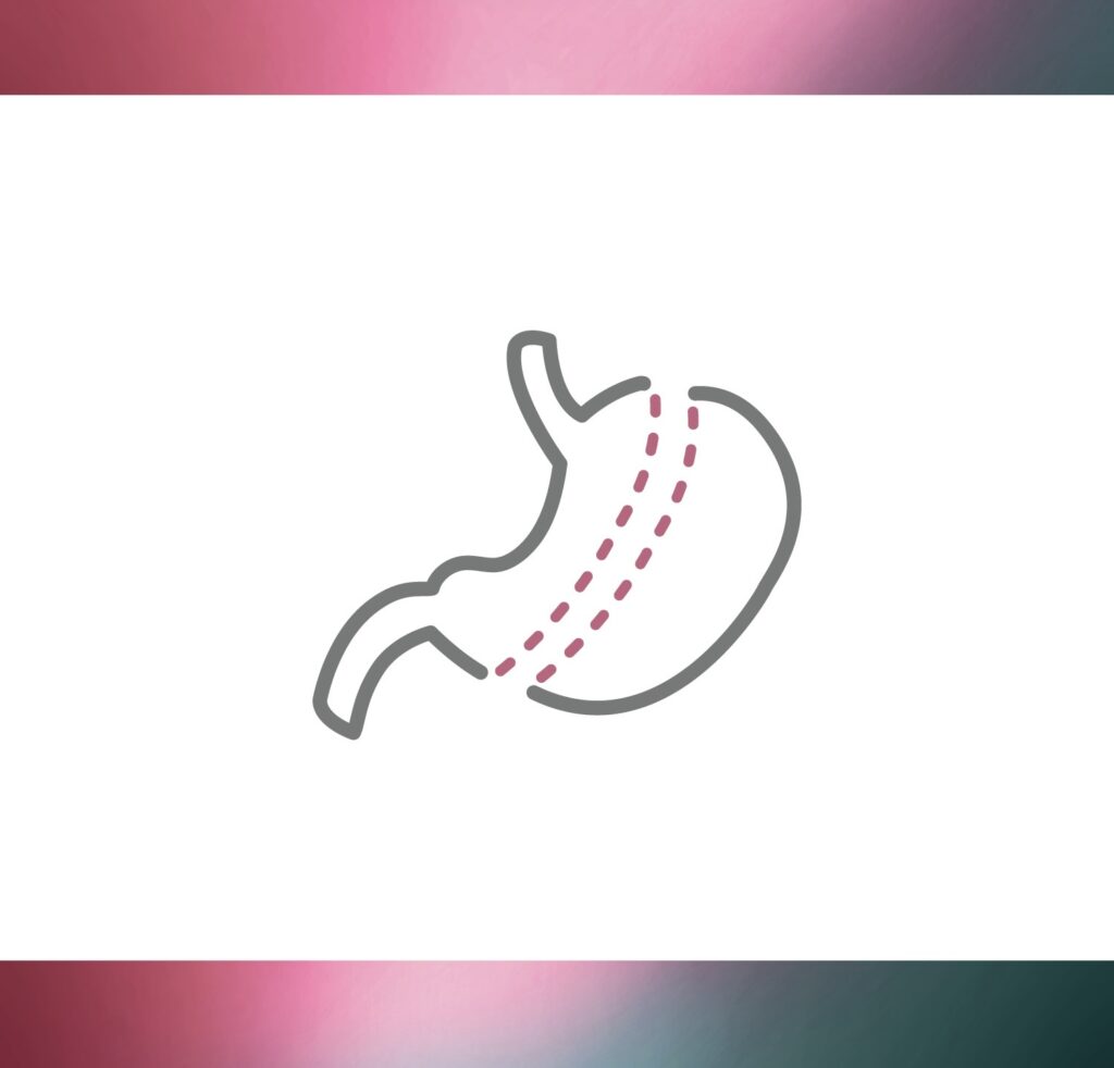 Laproscopic Gastric Sleeve