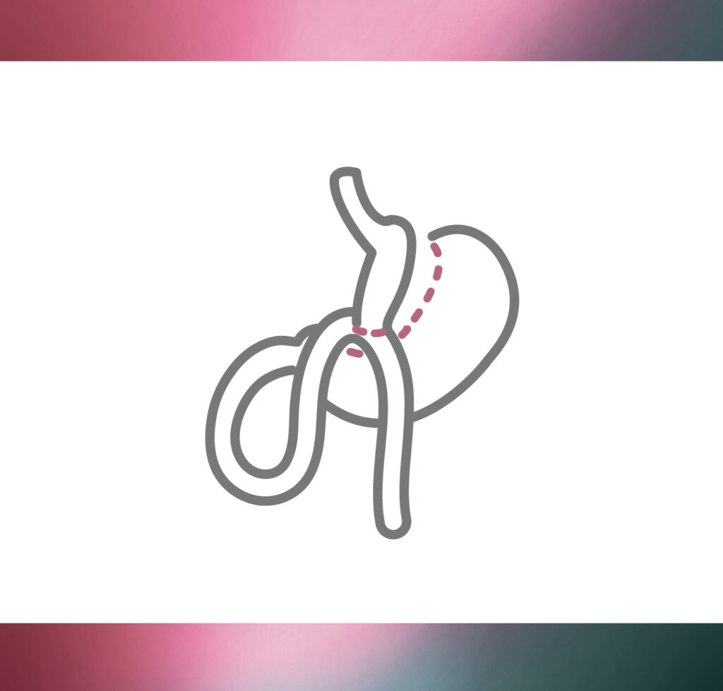 One Anastomosis Gastric Bypass