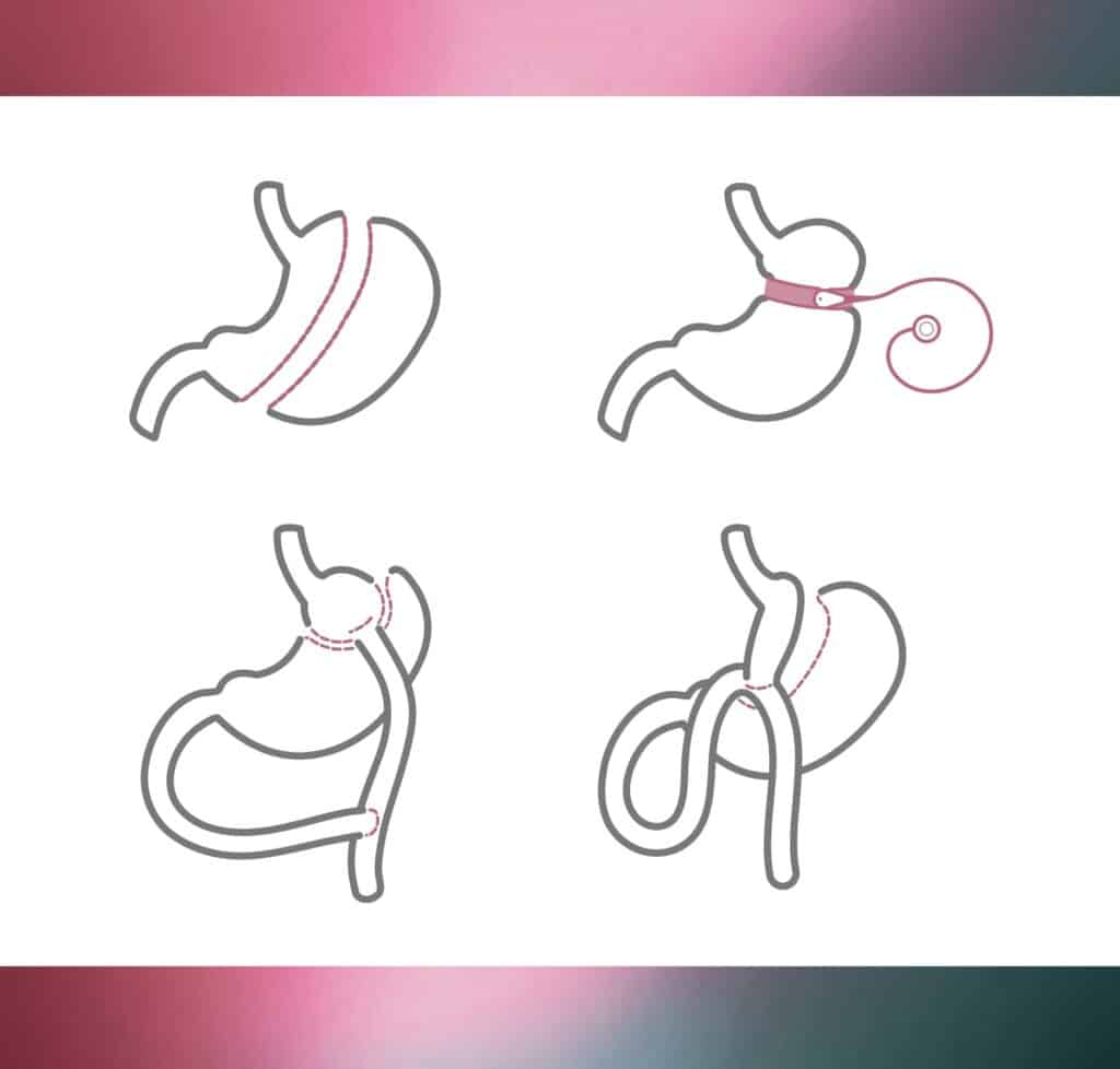 Types of Weight Loss Surgey