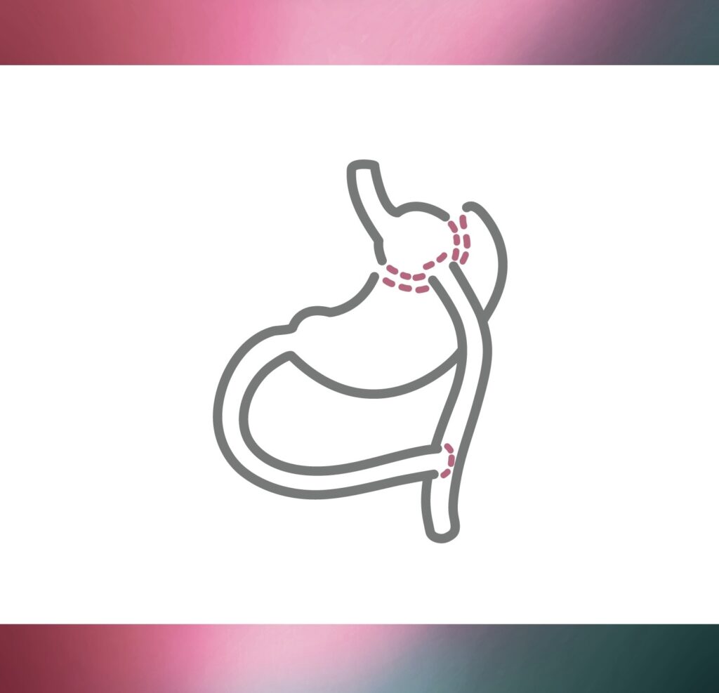 Roux-en-Y Gastric Bypass